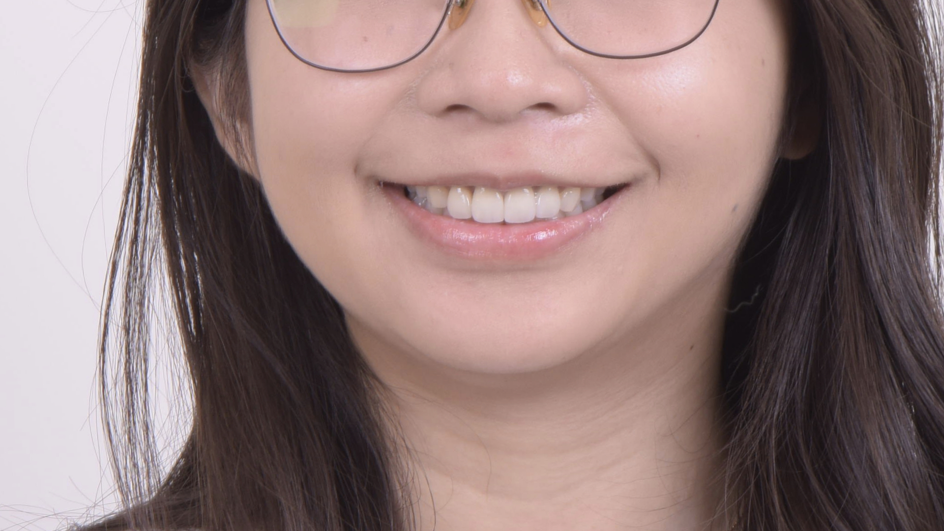 全瓷冠貼片完成