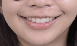 矯正後，牙齒整齊了，但牙齒黃黃的---美白與全瓷冠貼片修復