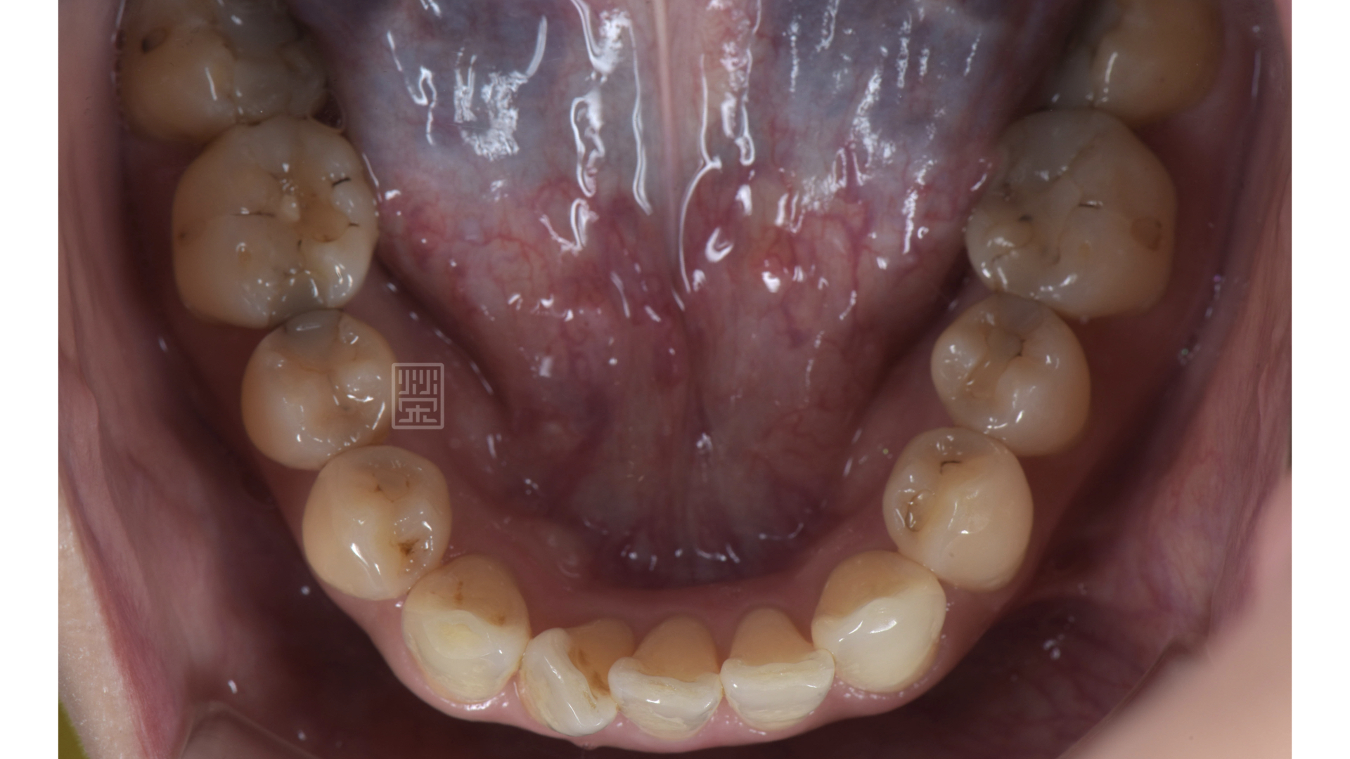 下顎後牙多處蛀牙