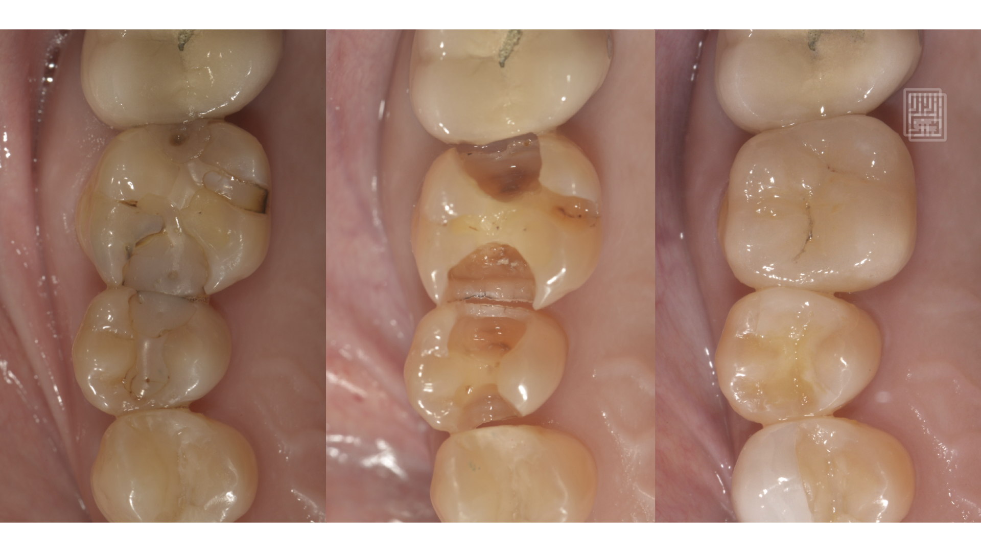 後牙全瓷嵌體修復