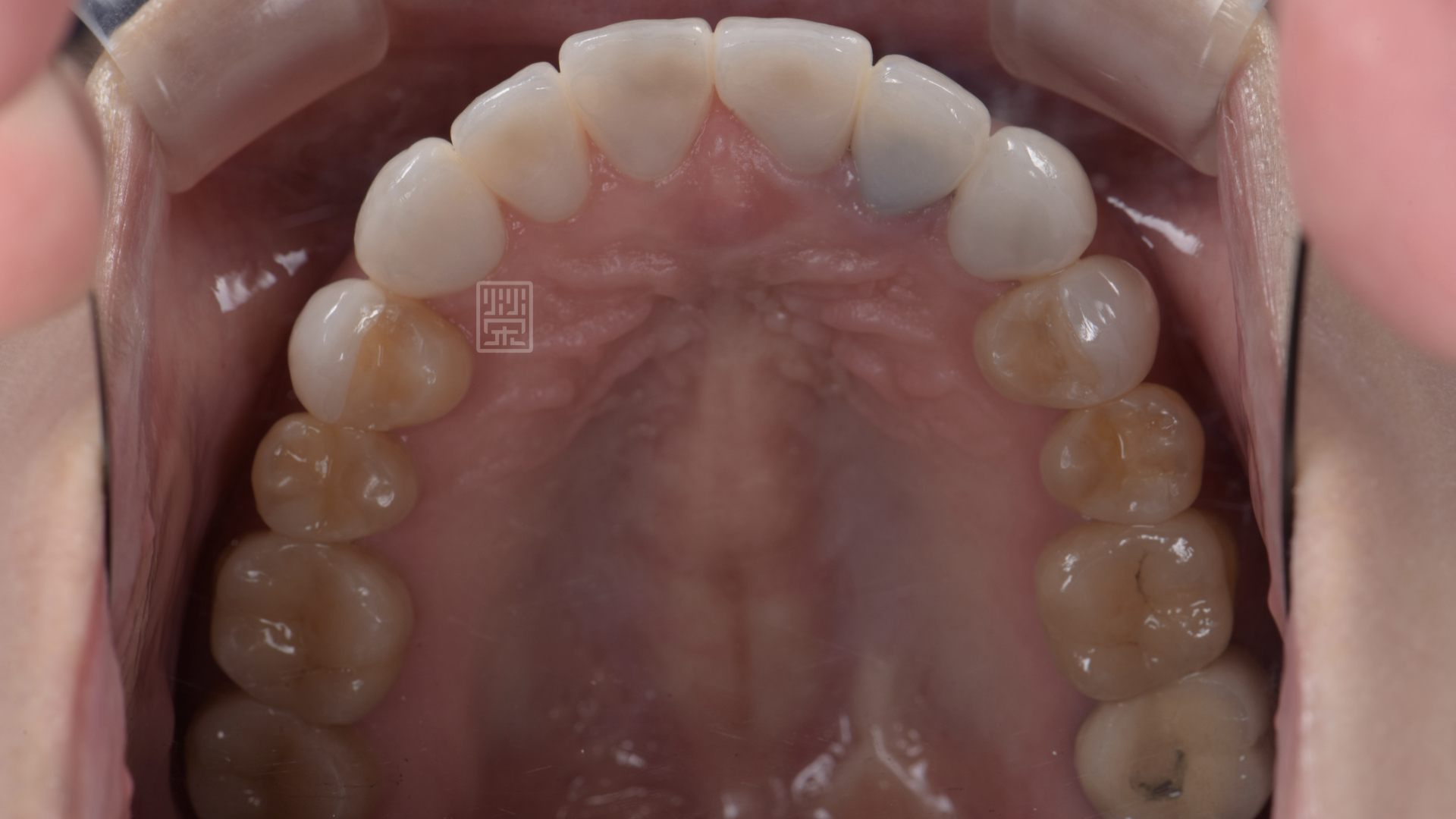 全瓷冠與後牙嵌體完成