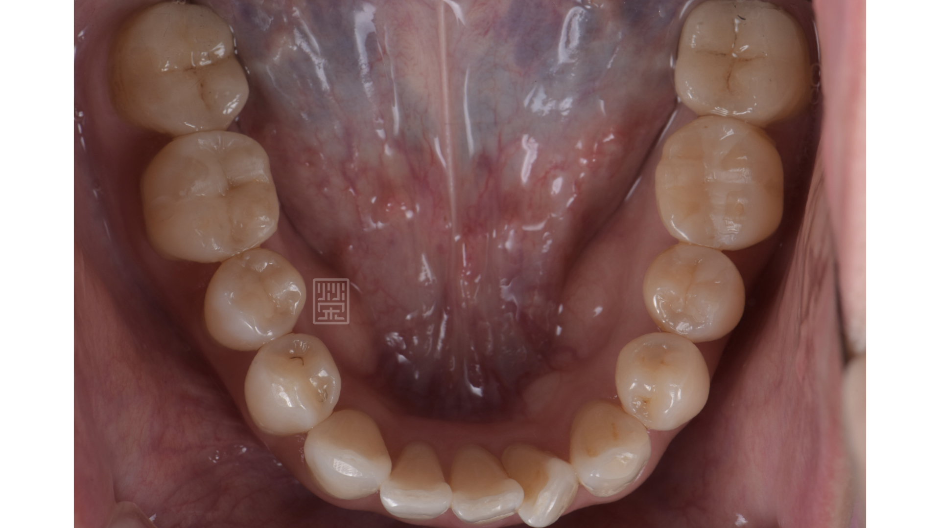 全瓷冠與後牙嵌體完成