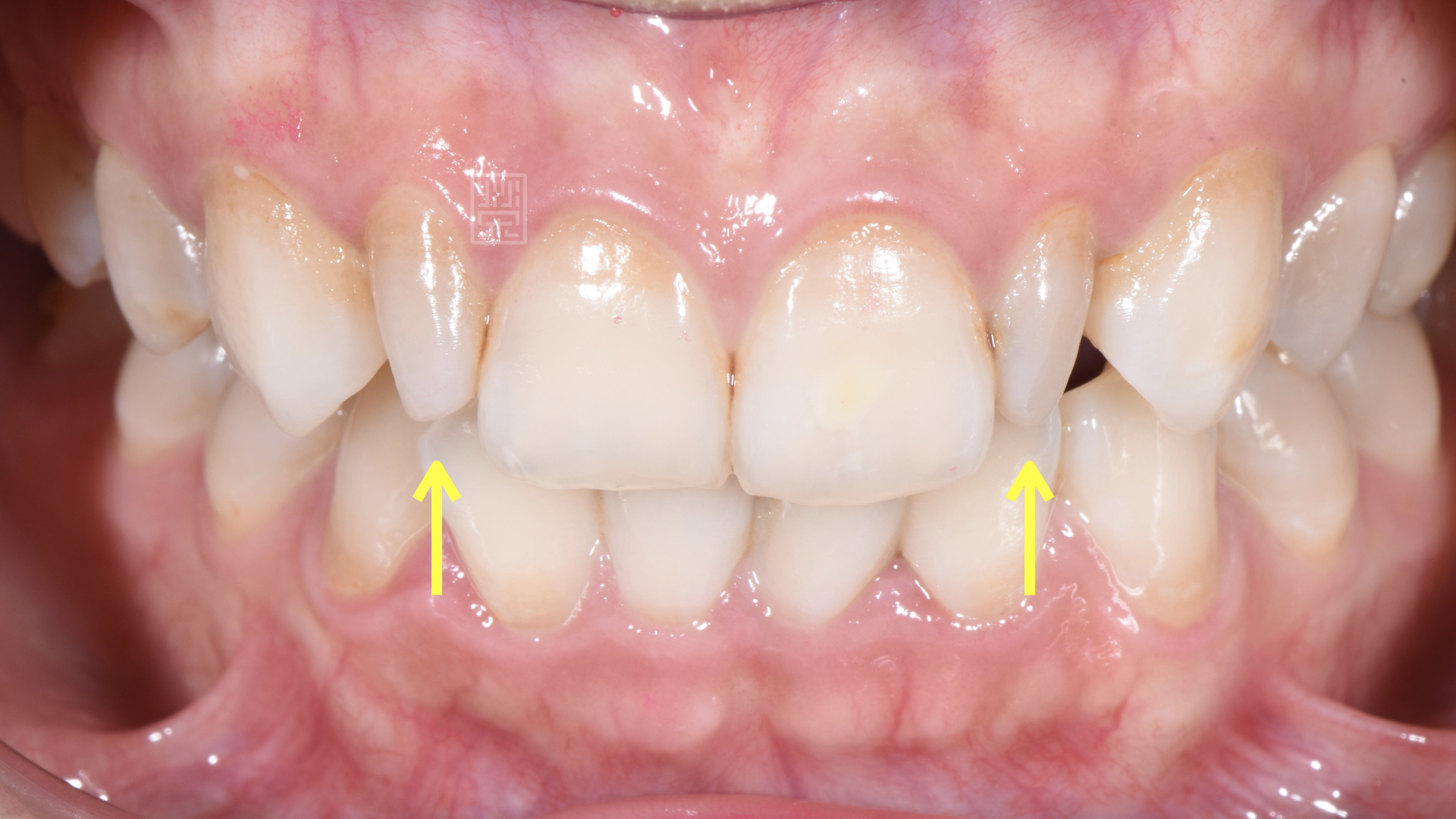 側門牙錐狀牙，型態比較小且尖