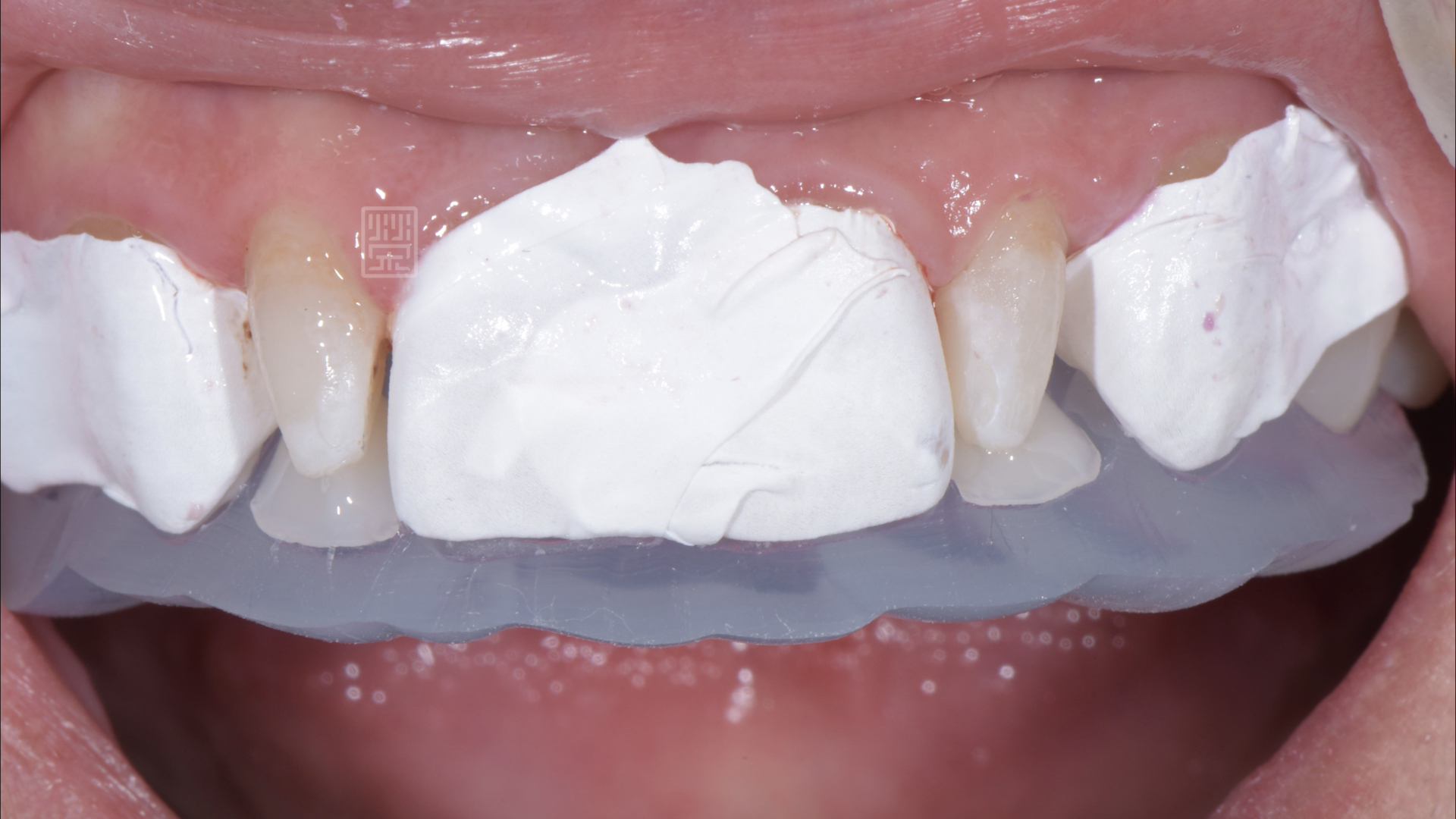 對合至口內預備復形