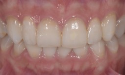 我的牙齒好小顆，該怎麼辦呢？------樹脂模擬、全瓷冠修復