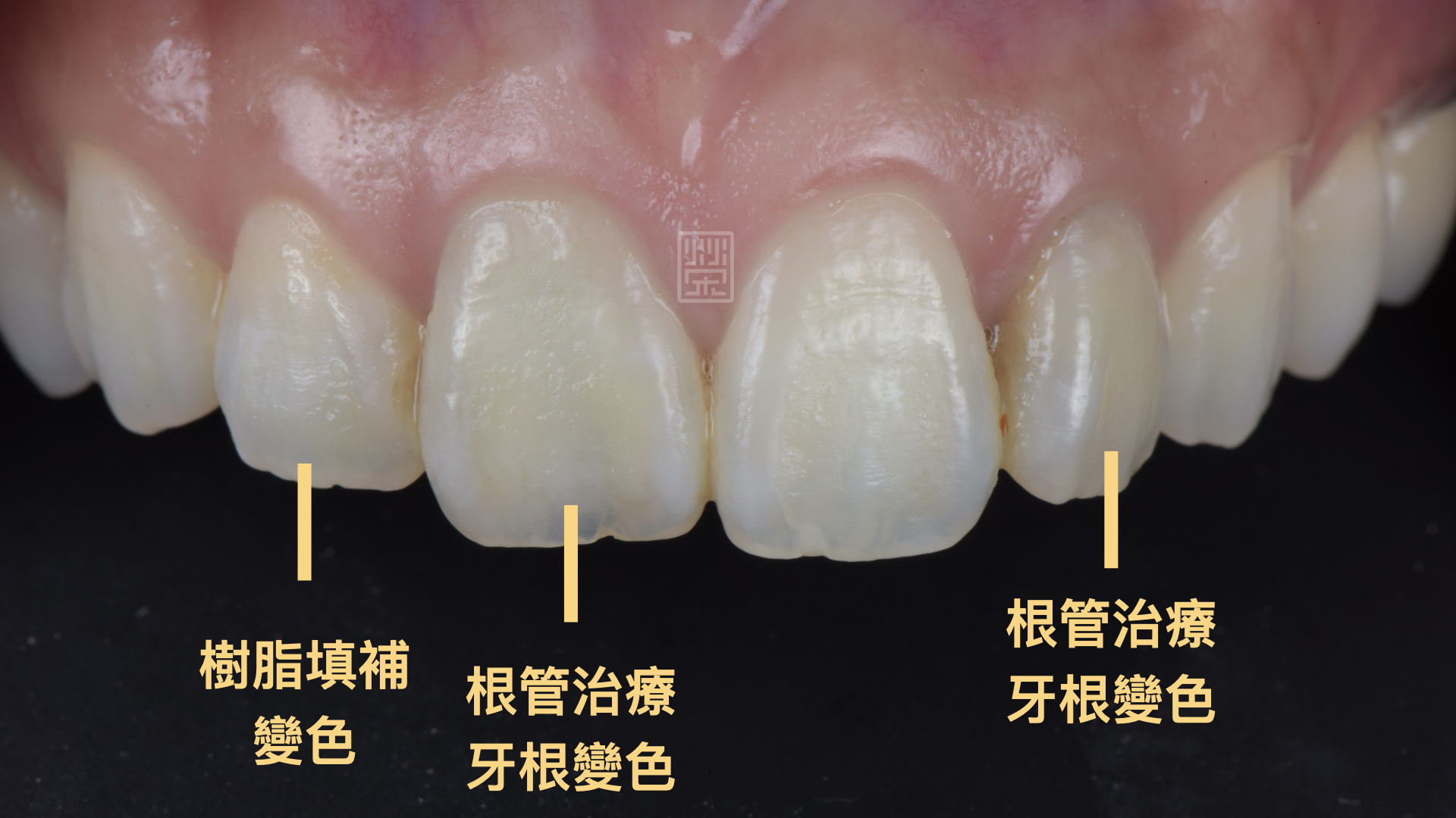 根管治療後牙齒變黑