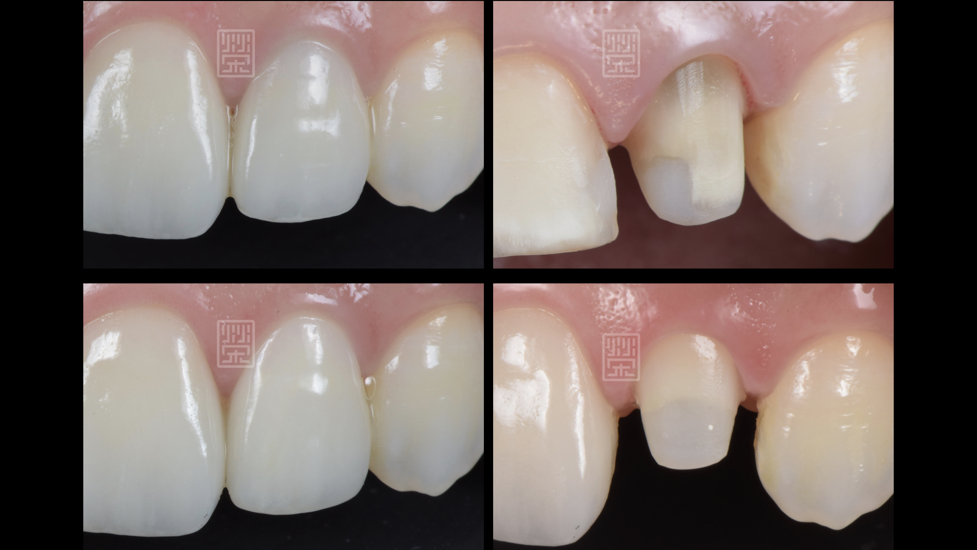 變色牙根會讓全瓷冠透出黑影