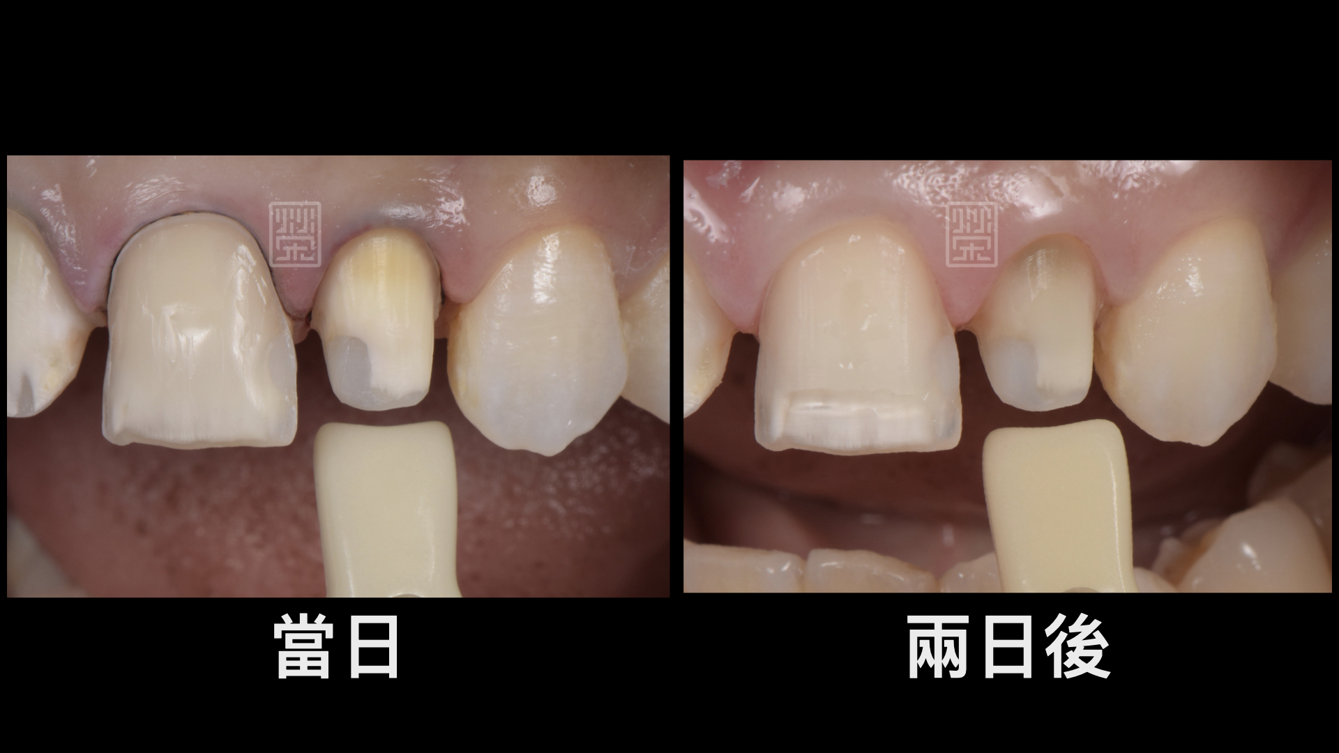 牙齒顏色會因脫水變色