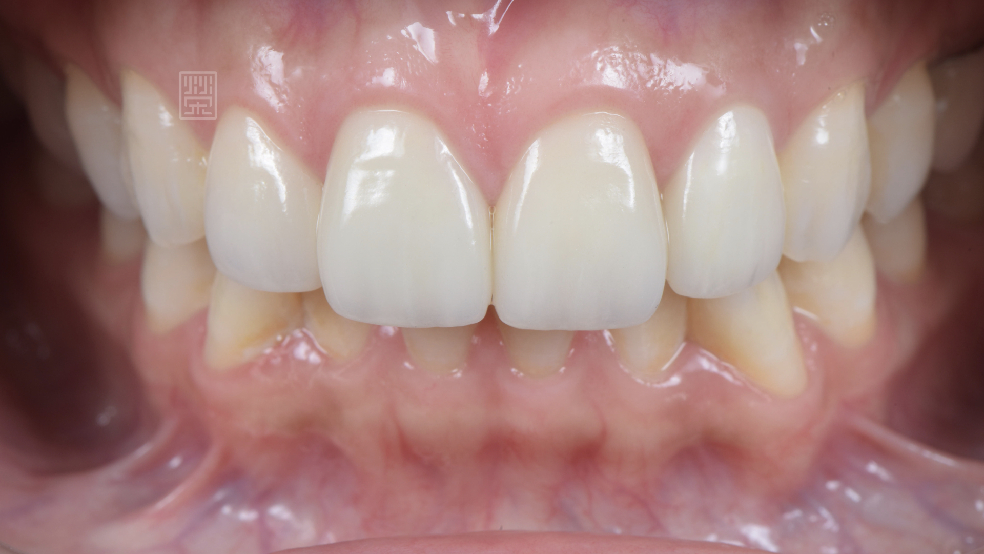 全瓷冠貼片完成