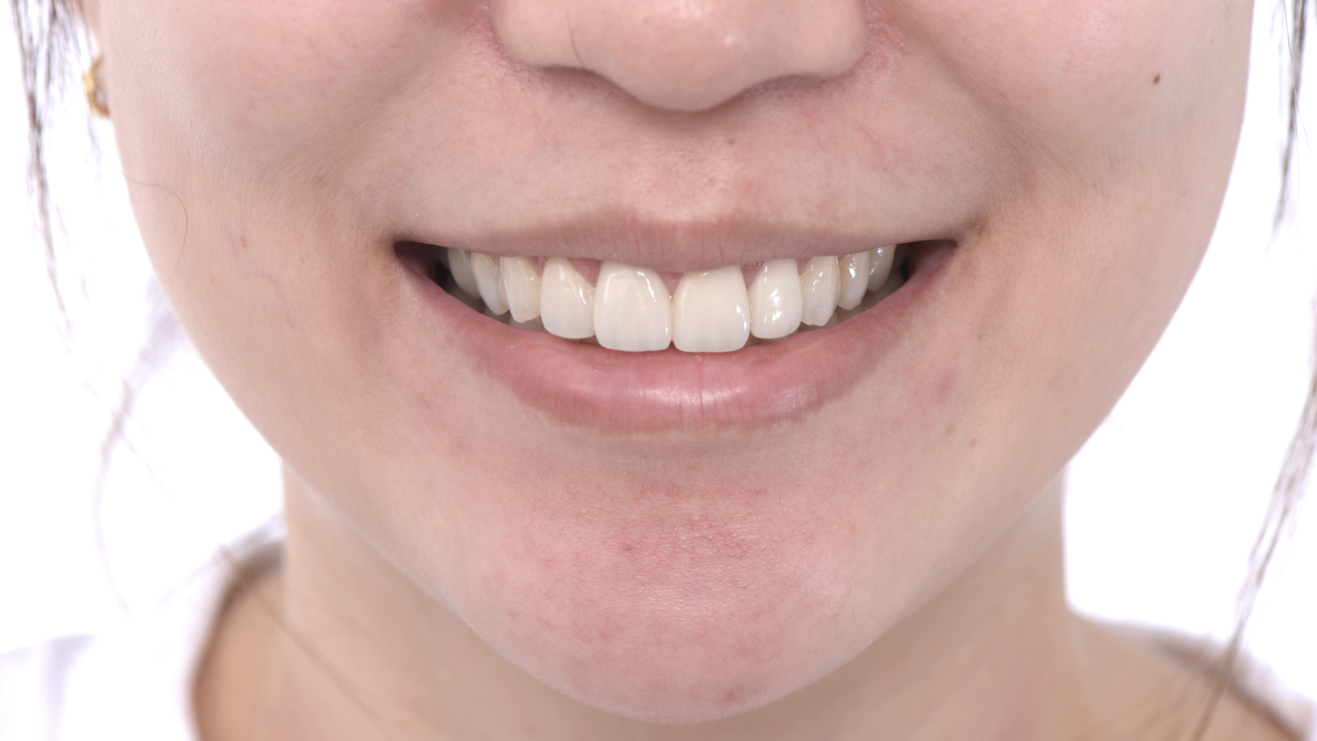 全瓷冠貼片符合微笑曲線