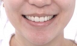 根管治療後牙齒變黑了，要怎麼處理呢------齒內美白後，全瓷冠貼片修復