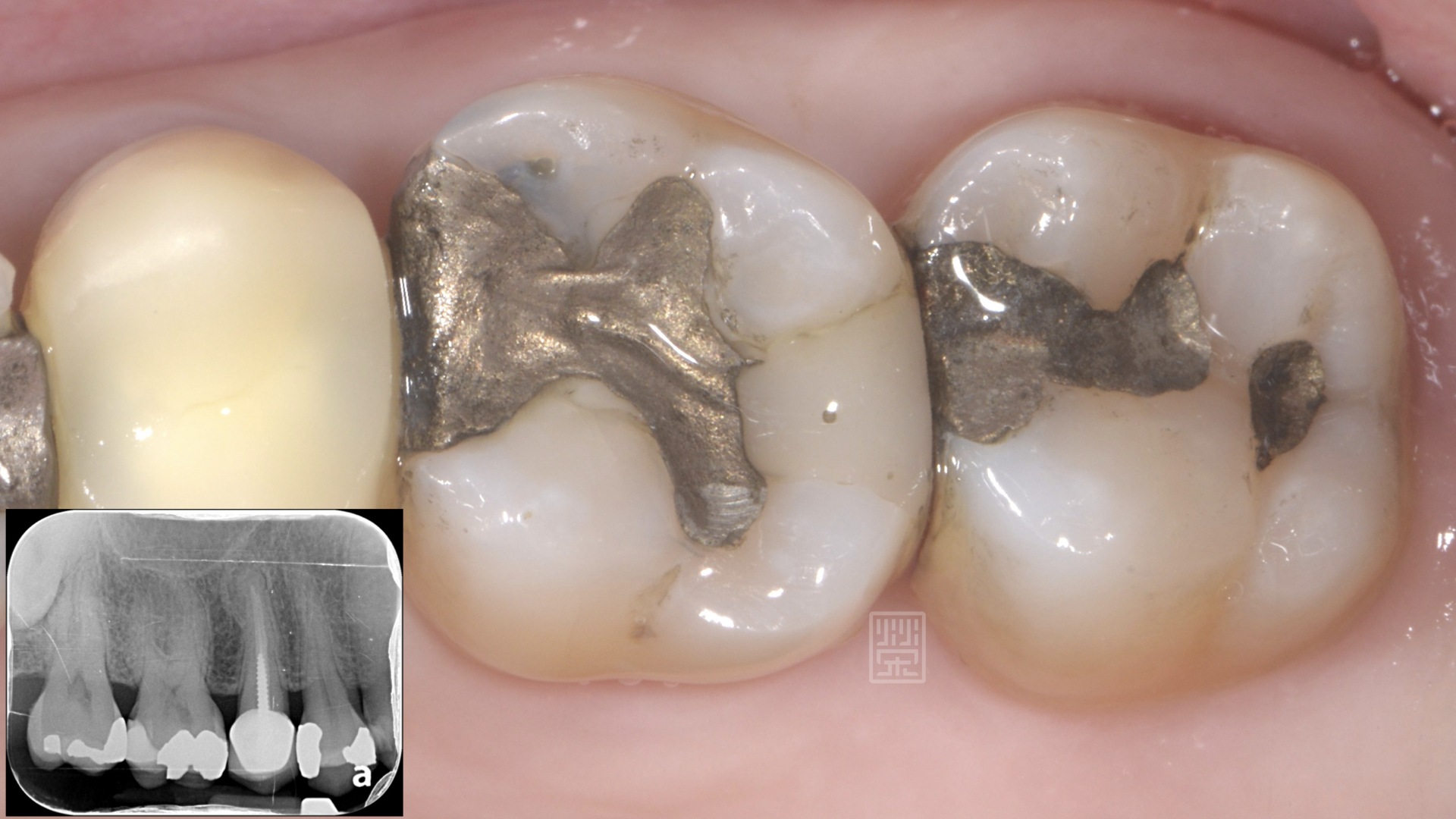 銀粉填補的第一大臼齒咬起來酸酸的