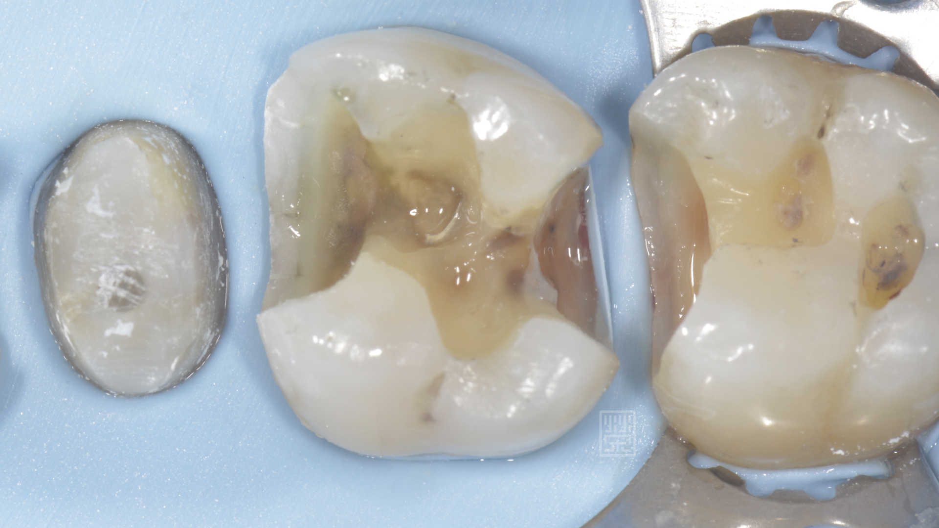 蛀牙清除後牙齒結構受損嚴重