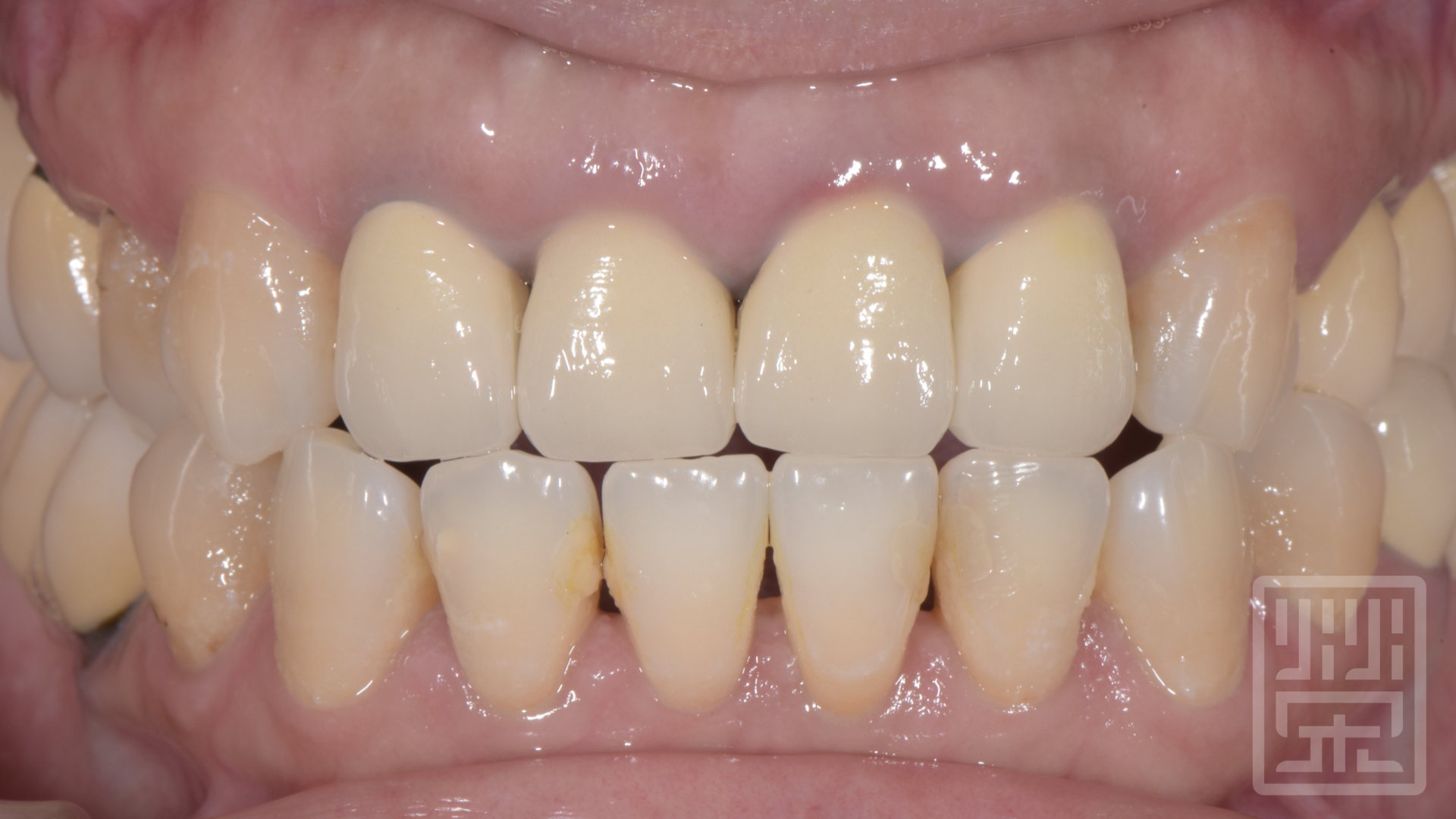 牙冠邊緣變色，牙齒黑三角縫