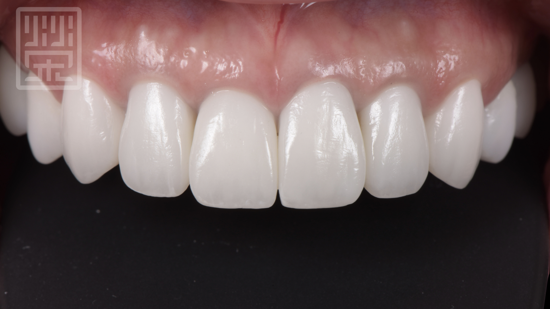 全瓷冠與貼片完成