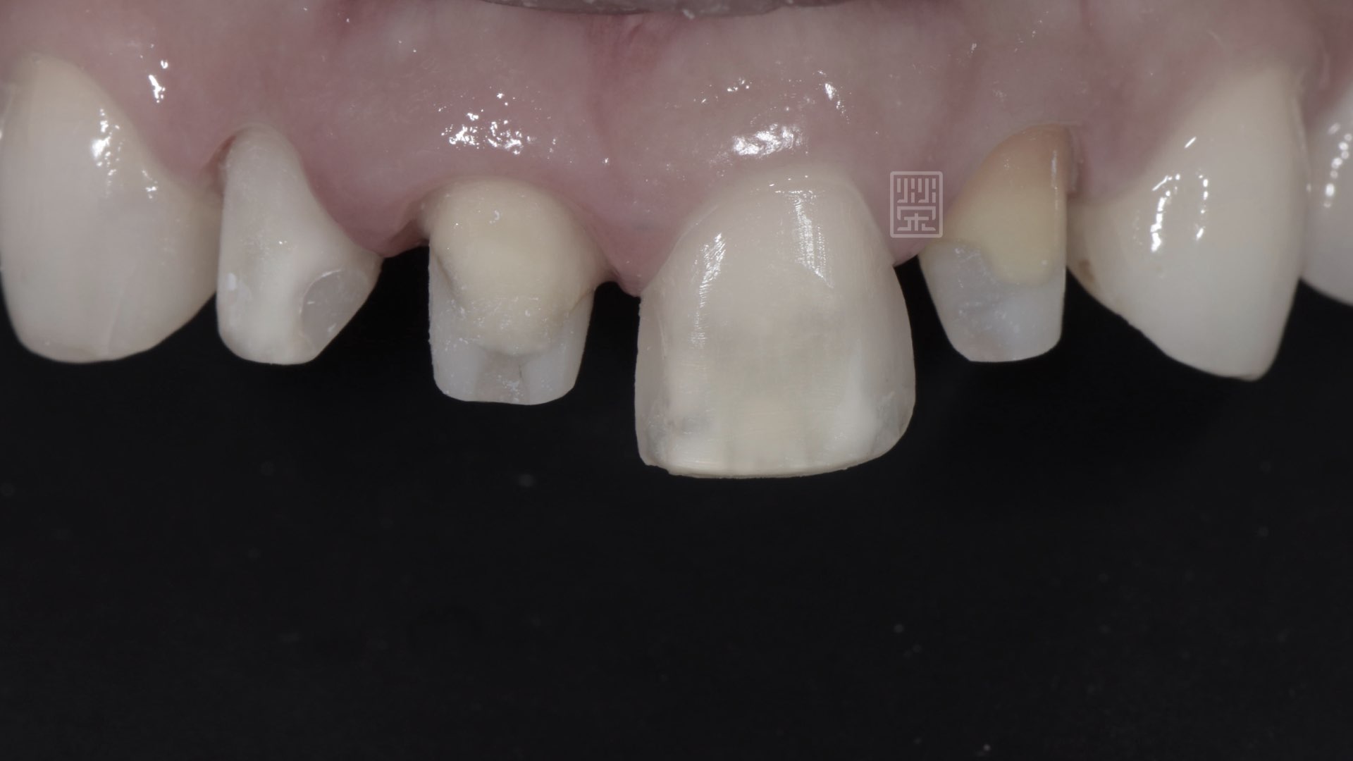 貼片與全瓷冠牙齒修整