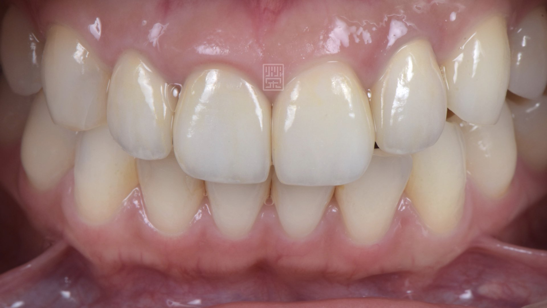全瓷冠與貼片搭配修復