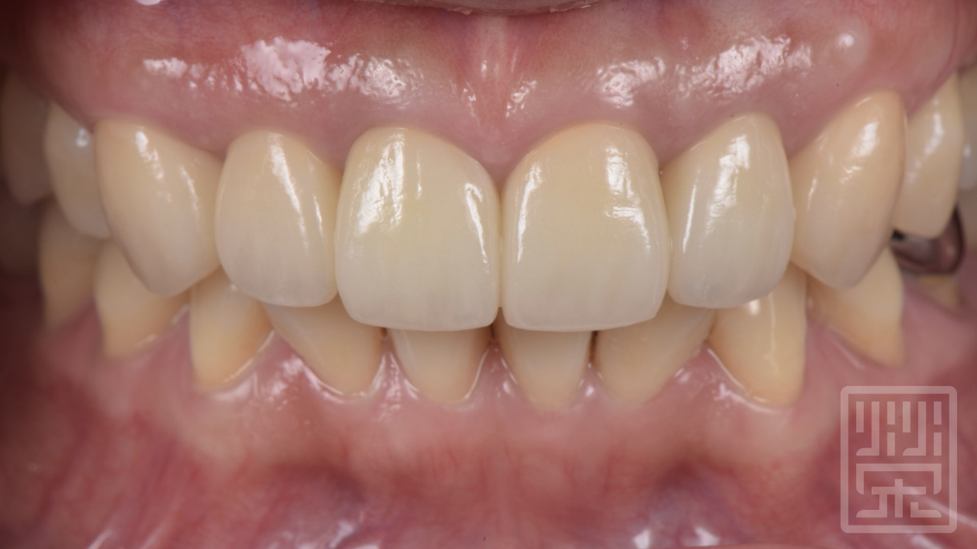 植牙全瓷冠修復