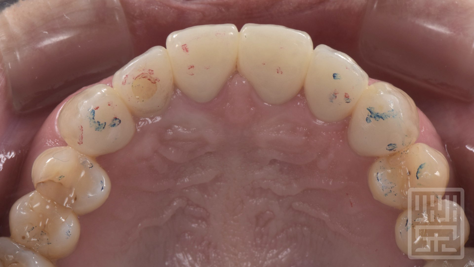 保護性咬合痕跡