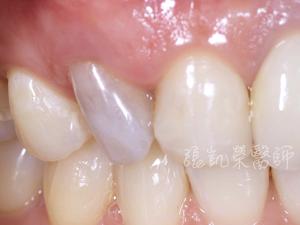 齒內美白前，牙齒變色