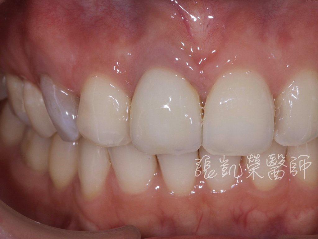 齒內美白前，犬齒變色很明顯