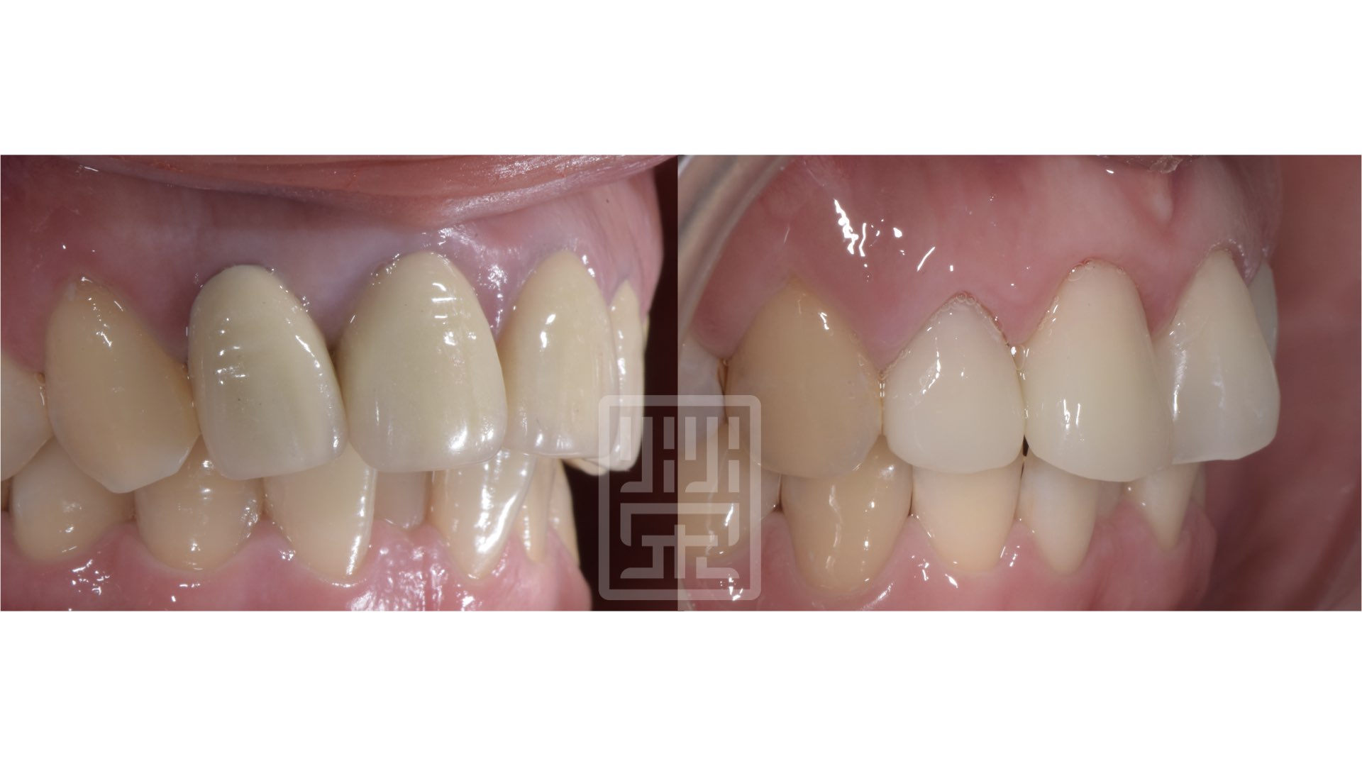 更換臨時假牙，並且模擬原先牙齒型態