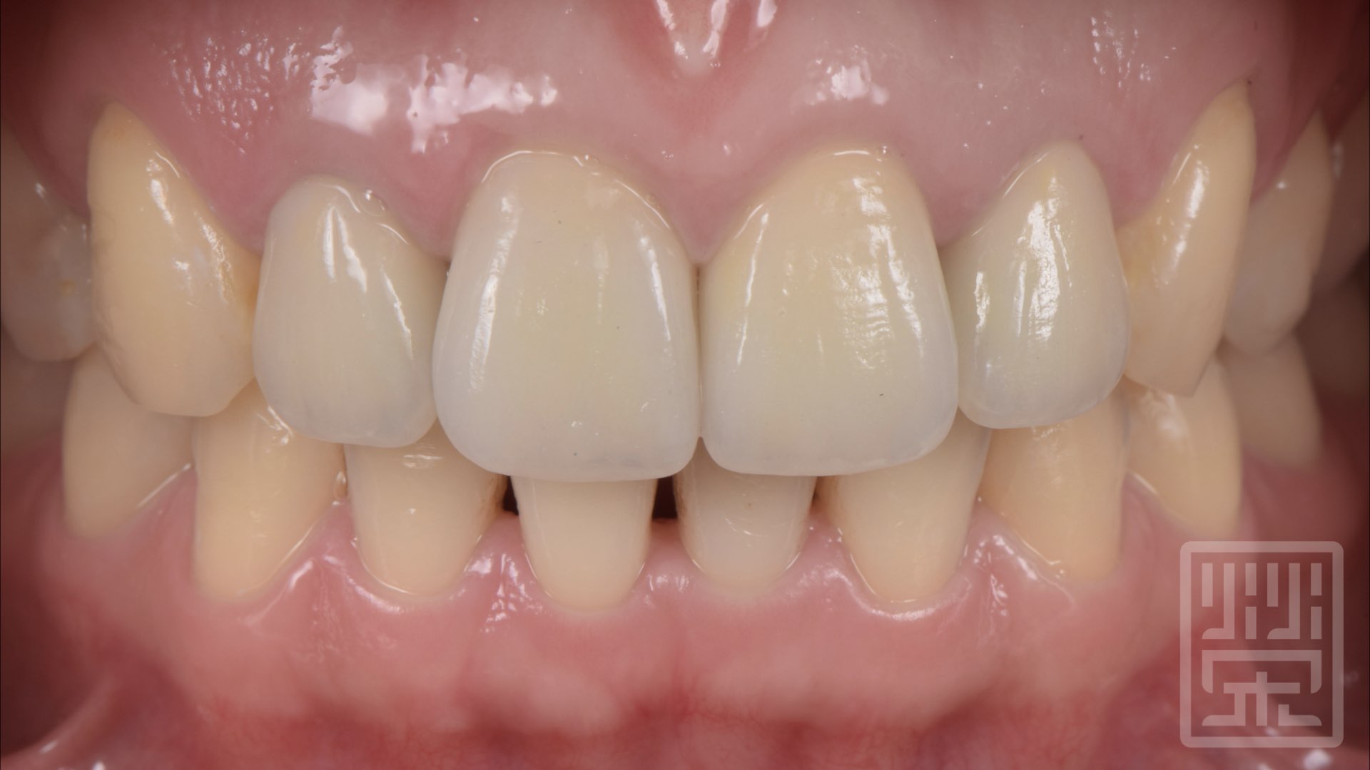 全瓷冠完成