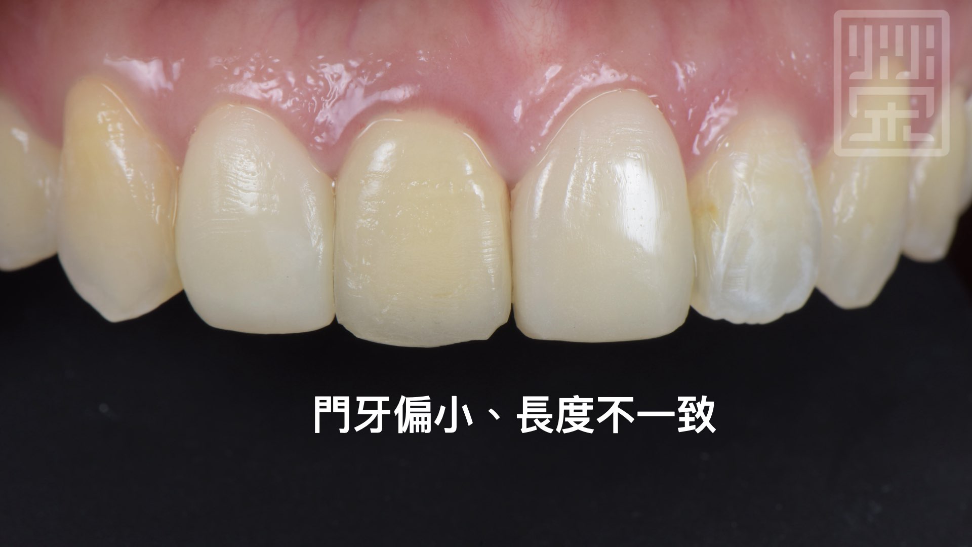 門牙偏小、長度不一樣