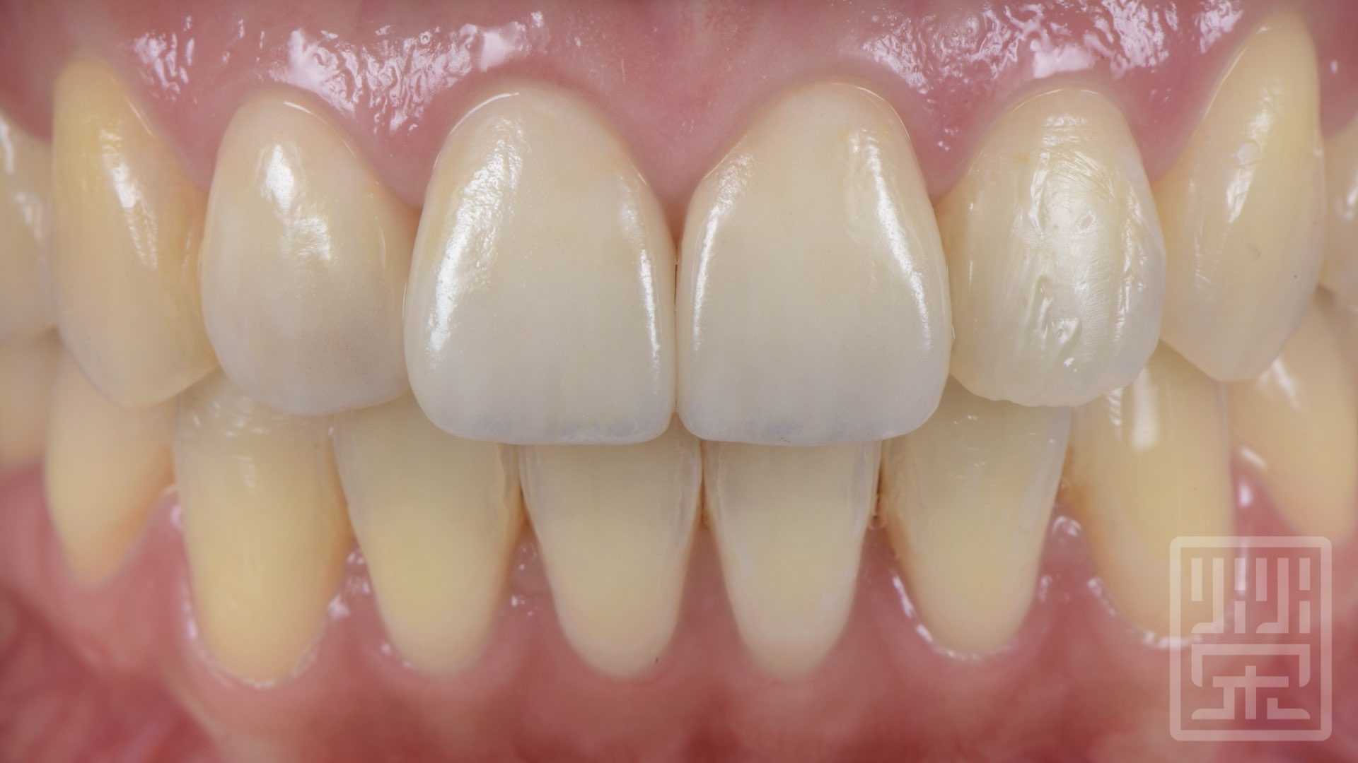 全瓷冠貼片完成