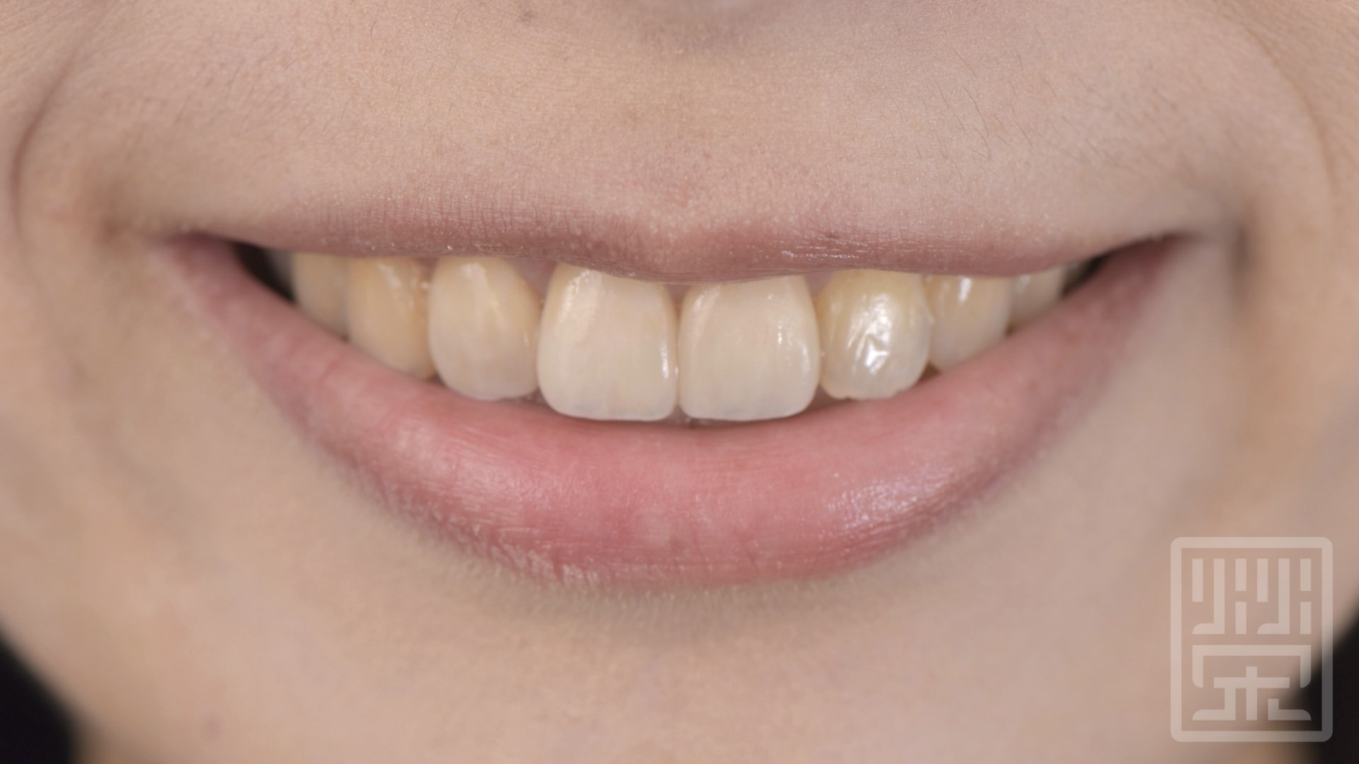 全瓷冠貼片完成