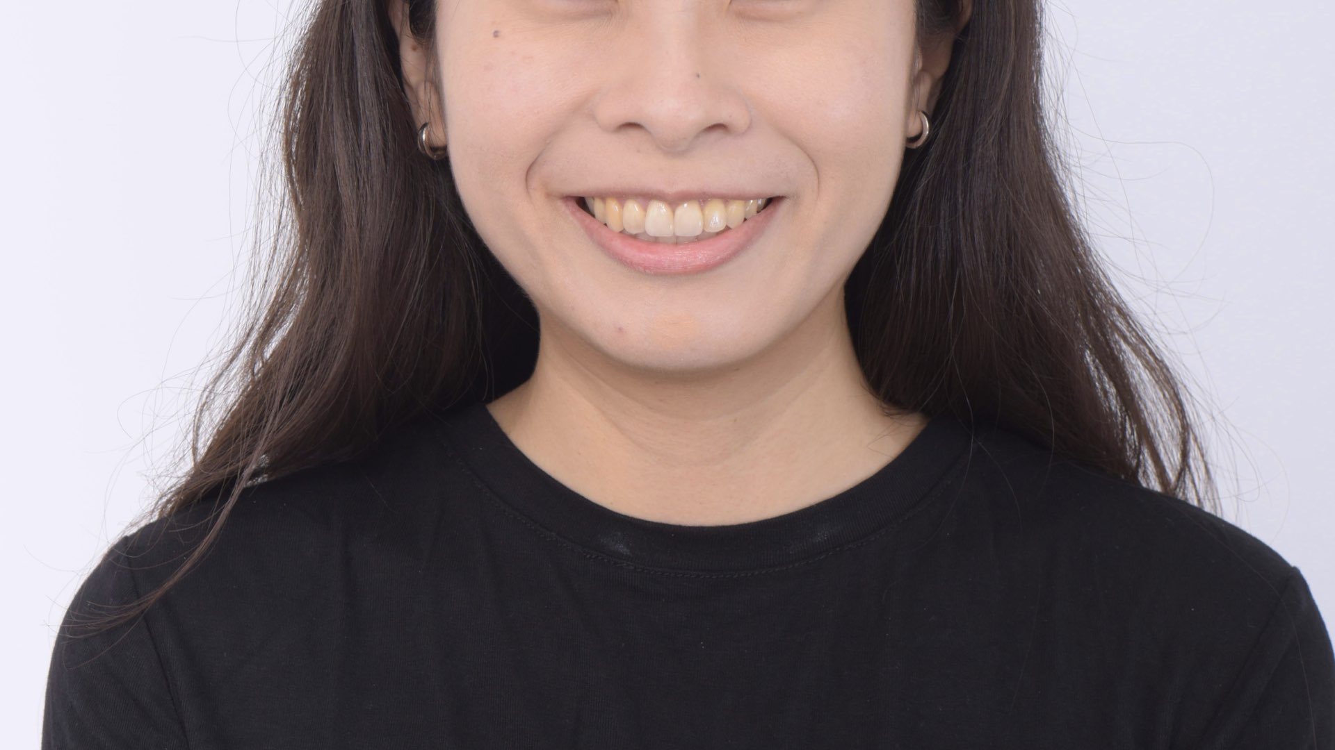 全瓷冠貼片完成