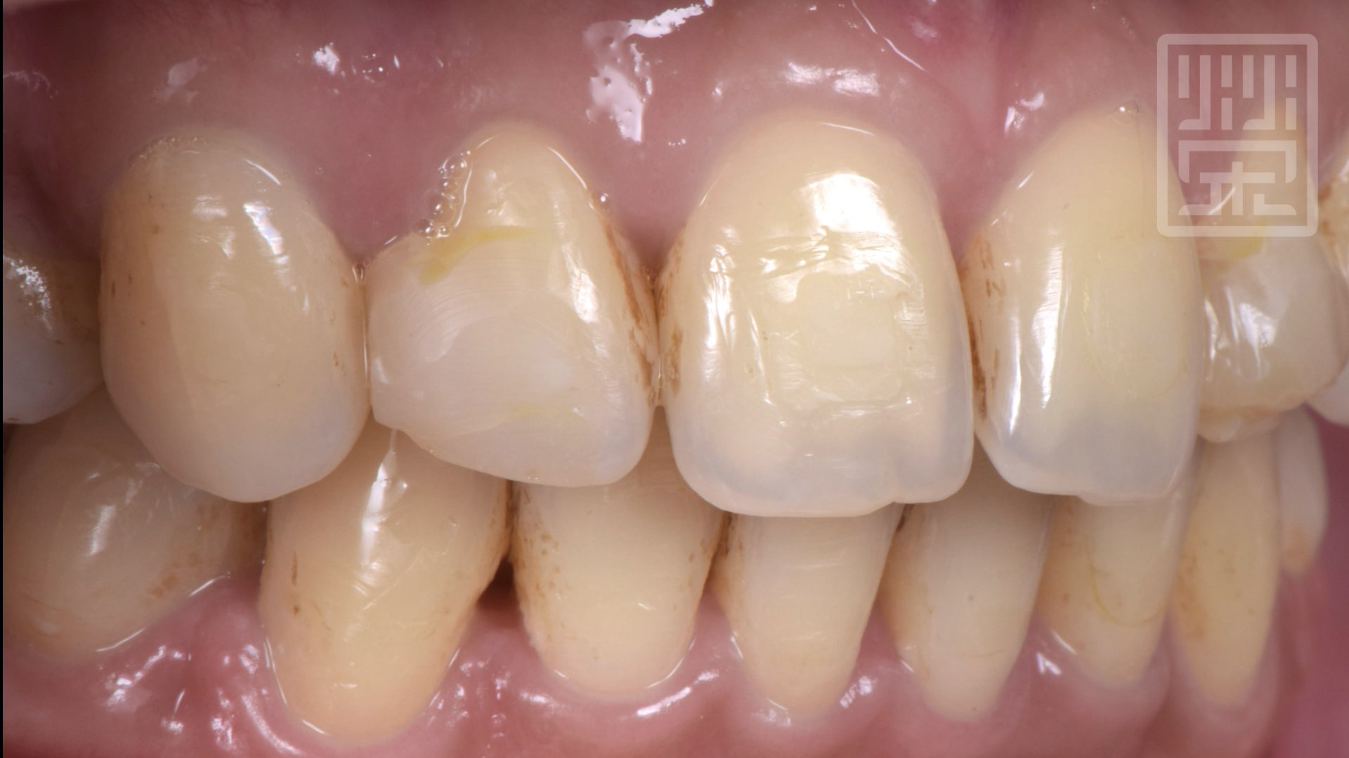 矯正後把牙縫用樹脂固定住