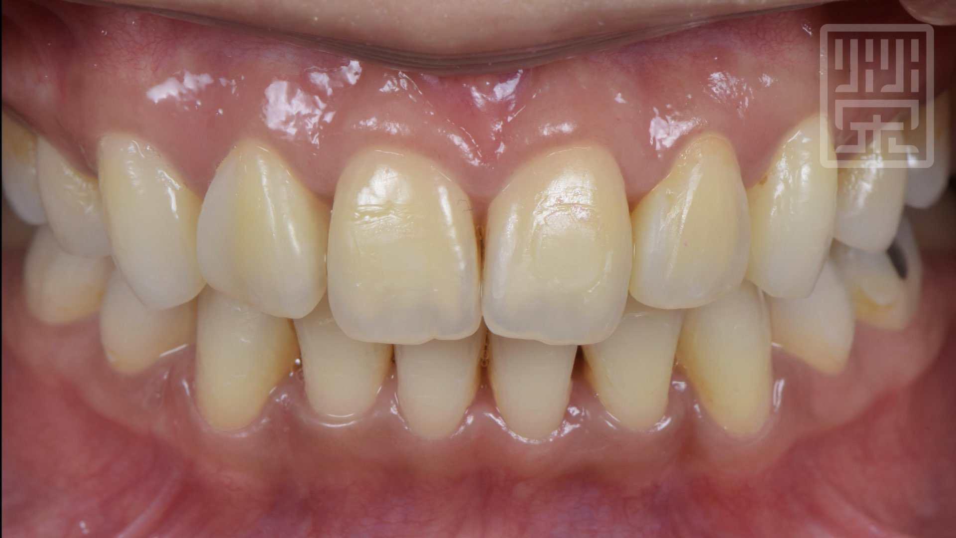 用樹脂改變牙齒型態