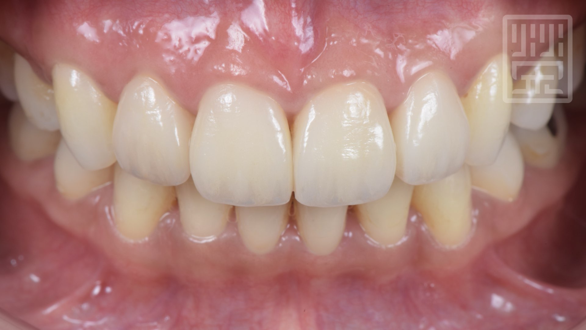 全瓷貼片全瓷冠完成