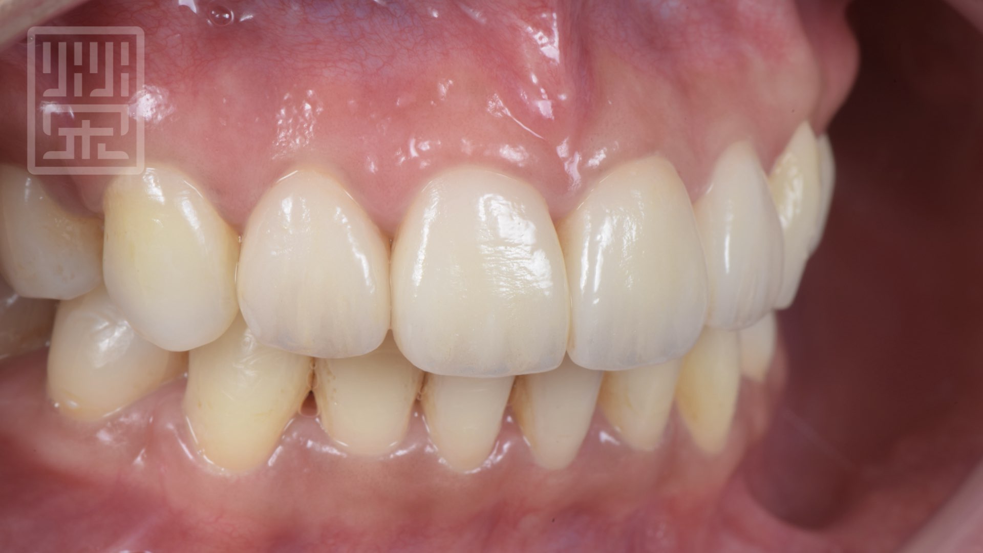 全瓷貼片全瓷冠完成