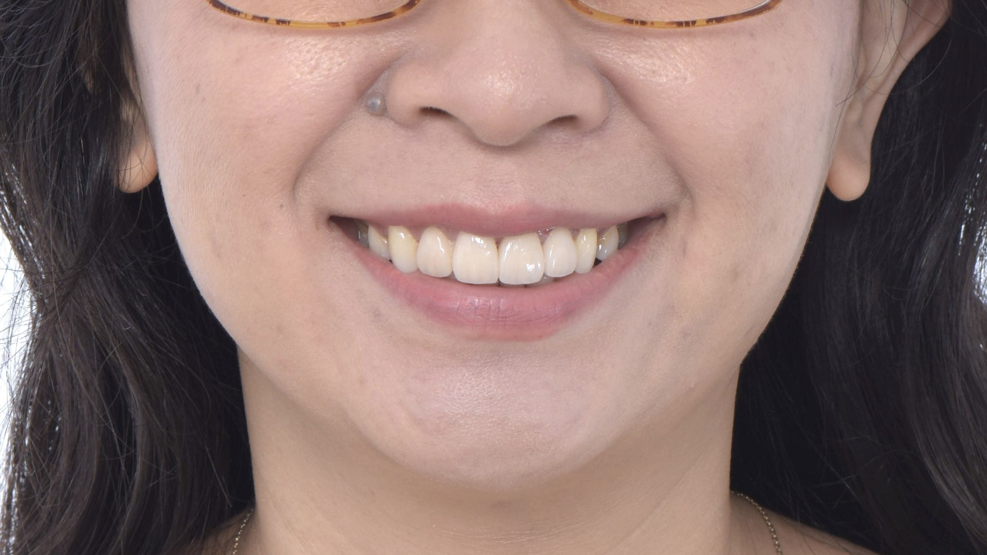 全瓷貼片全瓷冠完成