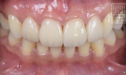 矯正後發現牙齒偏小------全瓷冠貼片修復