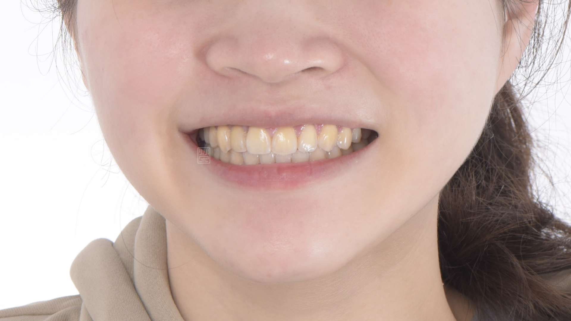 全瓷冠、植牙全瓷冠完成