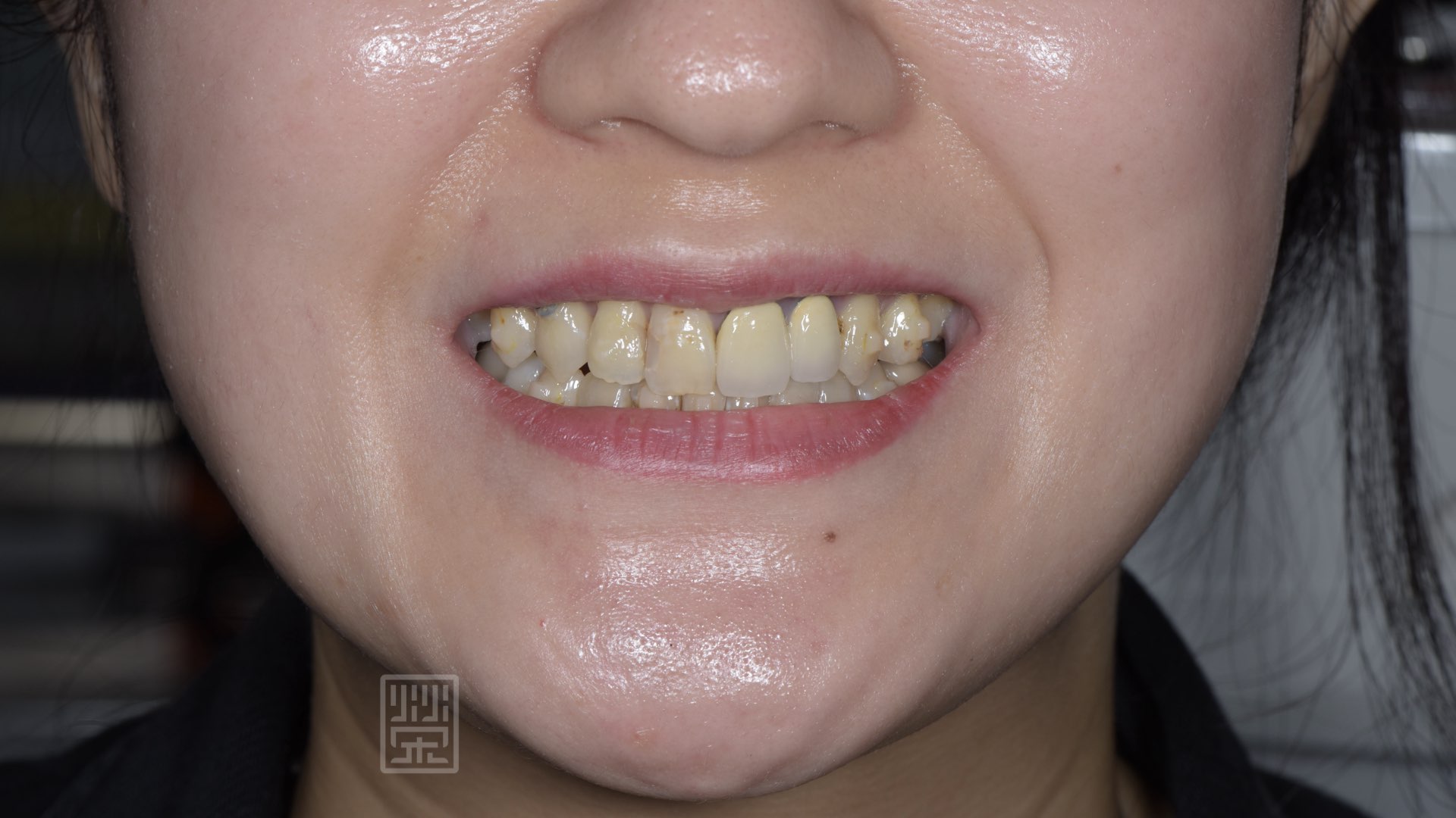 矯正後牙齒排列整齊，但是舊牙冠變色與舊樹脂變色