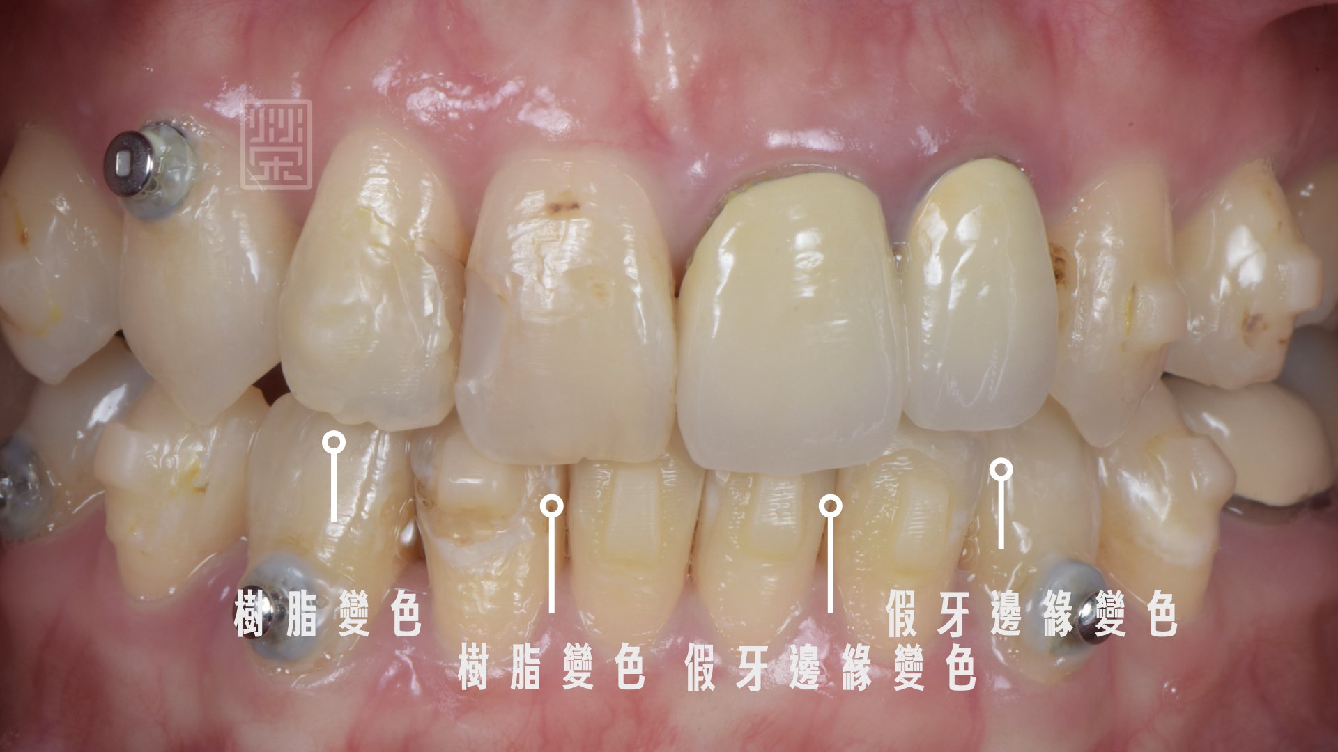 矯正後牙齒排列整齊，但是舊牙冠變色與舊樹脂變色