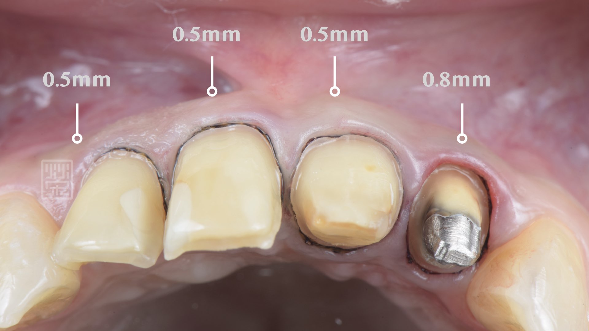 變色牙齒需要多一些空間