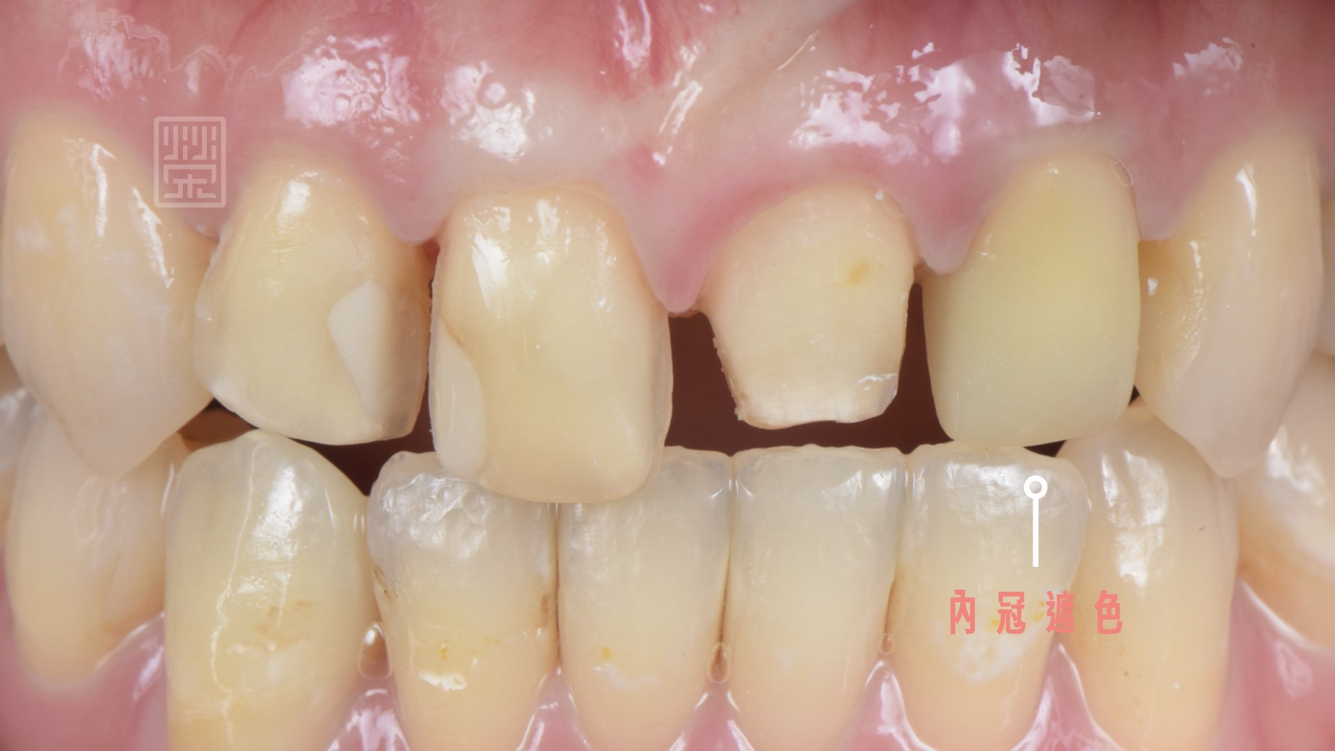 內層全瓷冠遮色