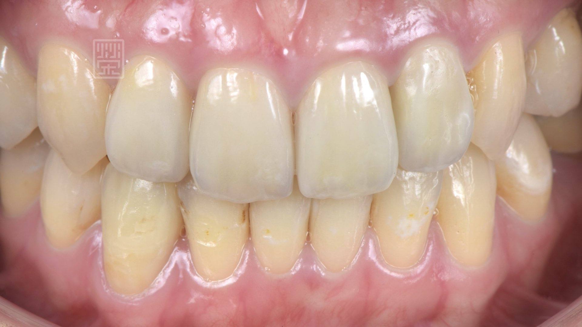 全瓷冠貼片完成