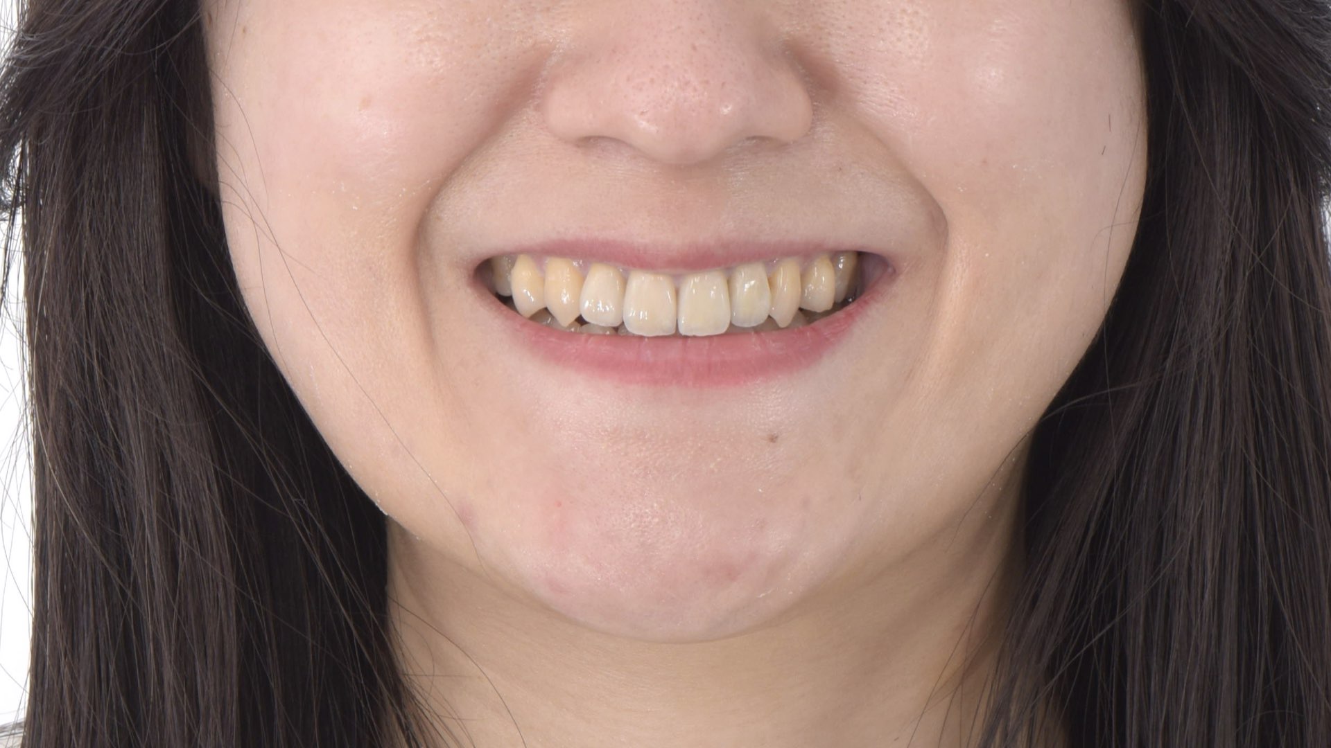 全瓷、牙齒、嘴唇和諧的笑容