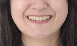 牙齒錯咬改善後，牙齒外觀不協調一致怎麼處理呢？------全瓷冠貼片修復，利用雙層冠改善變色牙根